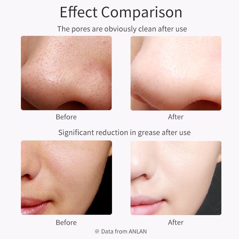 ANLAN Épurateur de peau faciale ultrasonique Profonde Visage Nettoyage Machine détacher Pelle Facial Pores Nettoyeur Soulever
